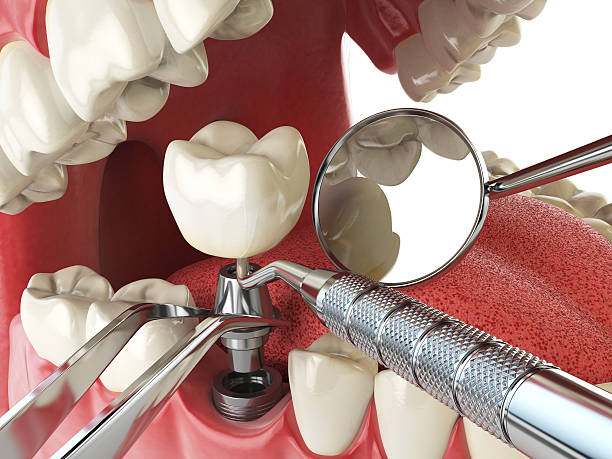 Best Emergency Broken Tooth Repair in Port Hadlock Irondale, WA